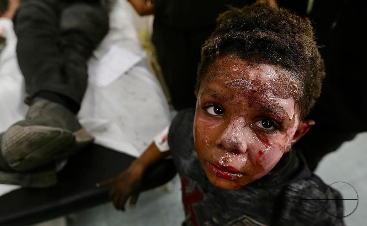 A Palestinian child whose face was burned due to an Israeli bombing of a house in Rafah, south of the Gaza Strip